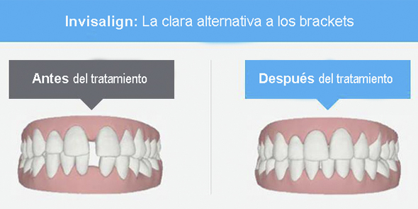 Clinica dental con Invisalign en Torrijos