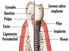 Las mejores tecnologías y avances a tu disposición en implantes dentales