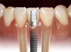 Descubre cómo funciona un implante dental